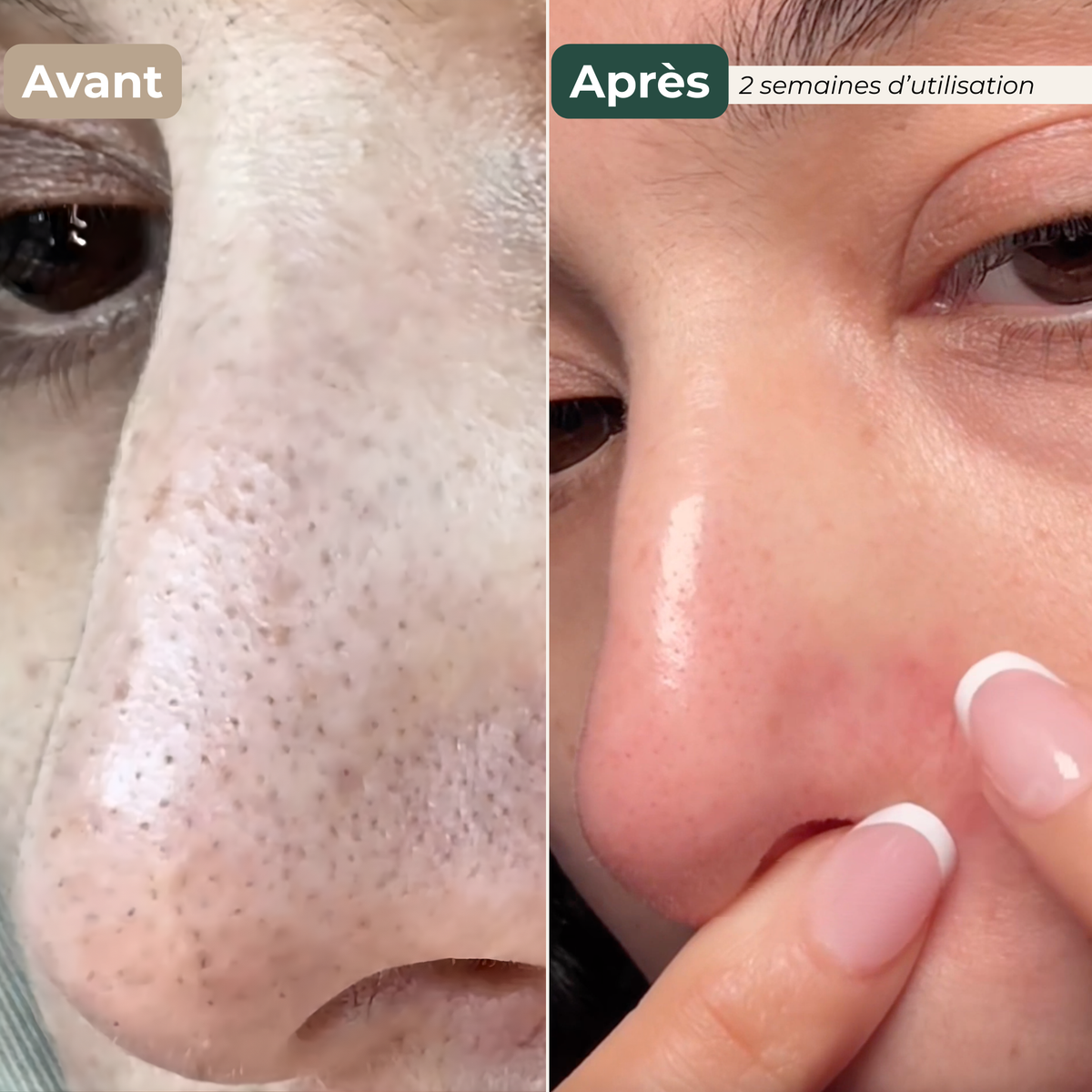 Patchs Purifiants Nez  Anti-Pores